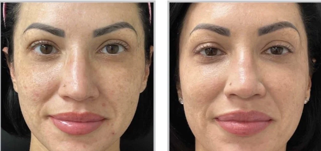 moxi laser Nottingham