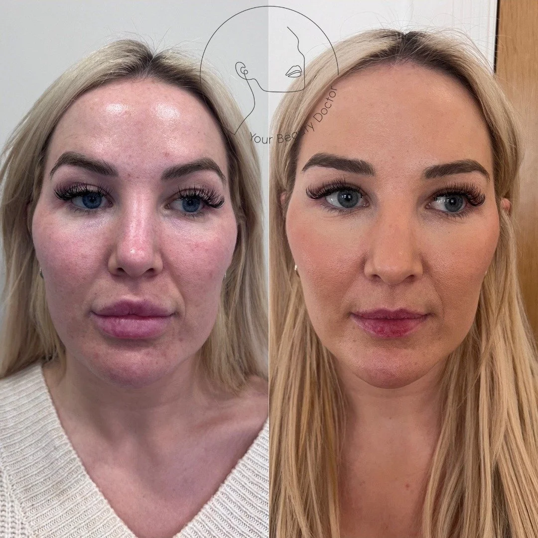 When filler is done well, you shouldn&rsquo;t really notice it.

You should just look well - balanced, rested, like you.

But this patient came to me feeling the opposite. Her face felt heavy, swollen, and not her own.

She&rsquo;d been over treated 