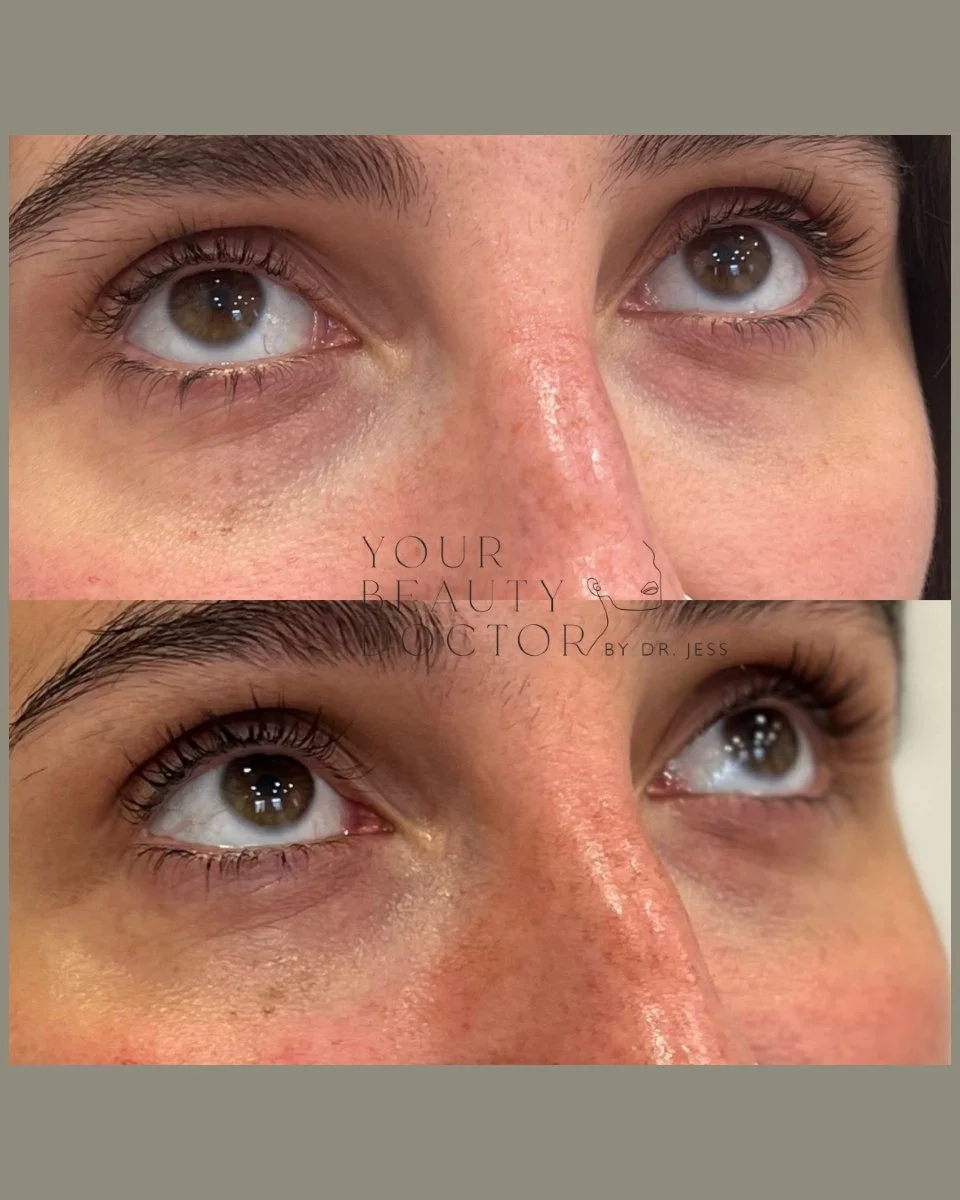 Dark circles, hollowness and that dull, shadowed look can be caused by a mix of factors: genetics, skin thinning, volume loss, and pigmentation. And often, no amount of concealer really fixes it.

This patient didn&rsquo;t want to change her face - s