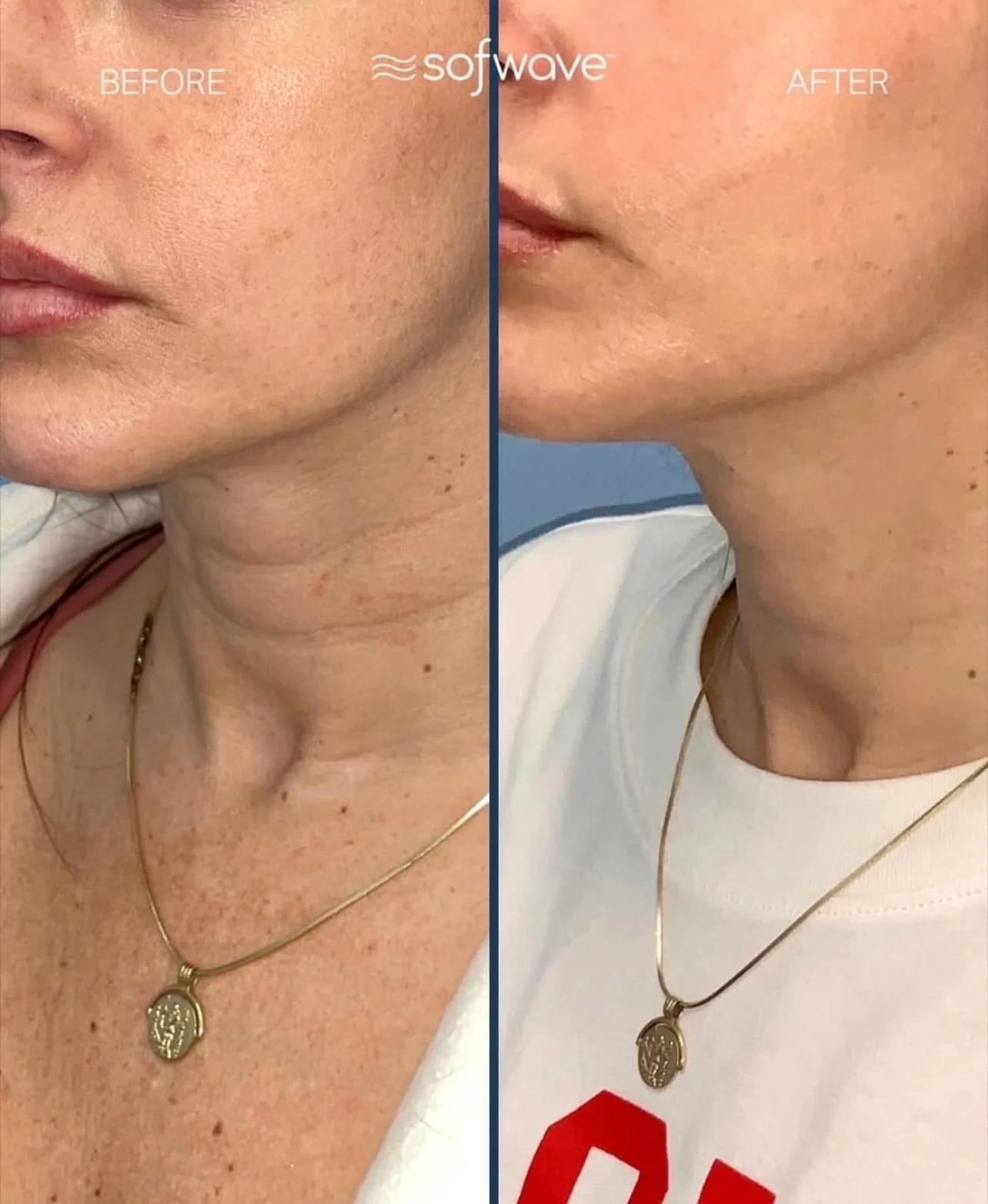 Sofwave for collagen production