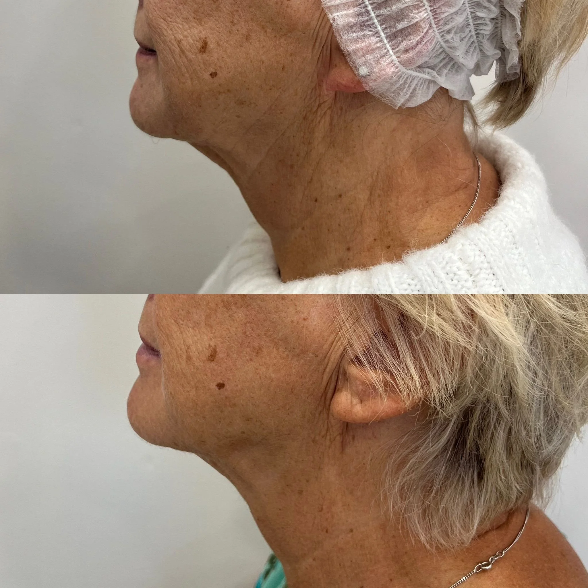 Sofwave for collagen production