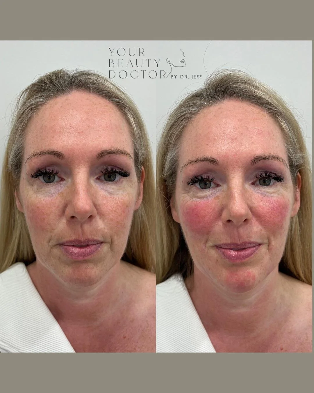 Temple Fillers Nottinghamshire