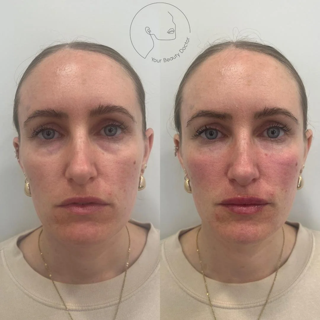 Cheek Fillers Nottingham