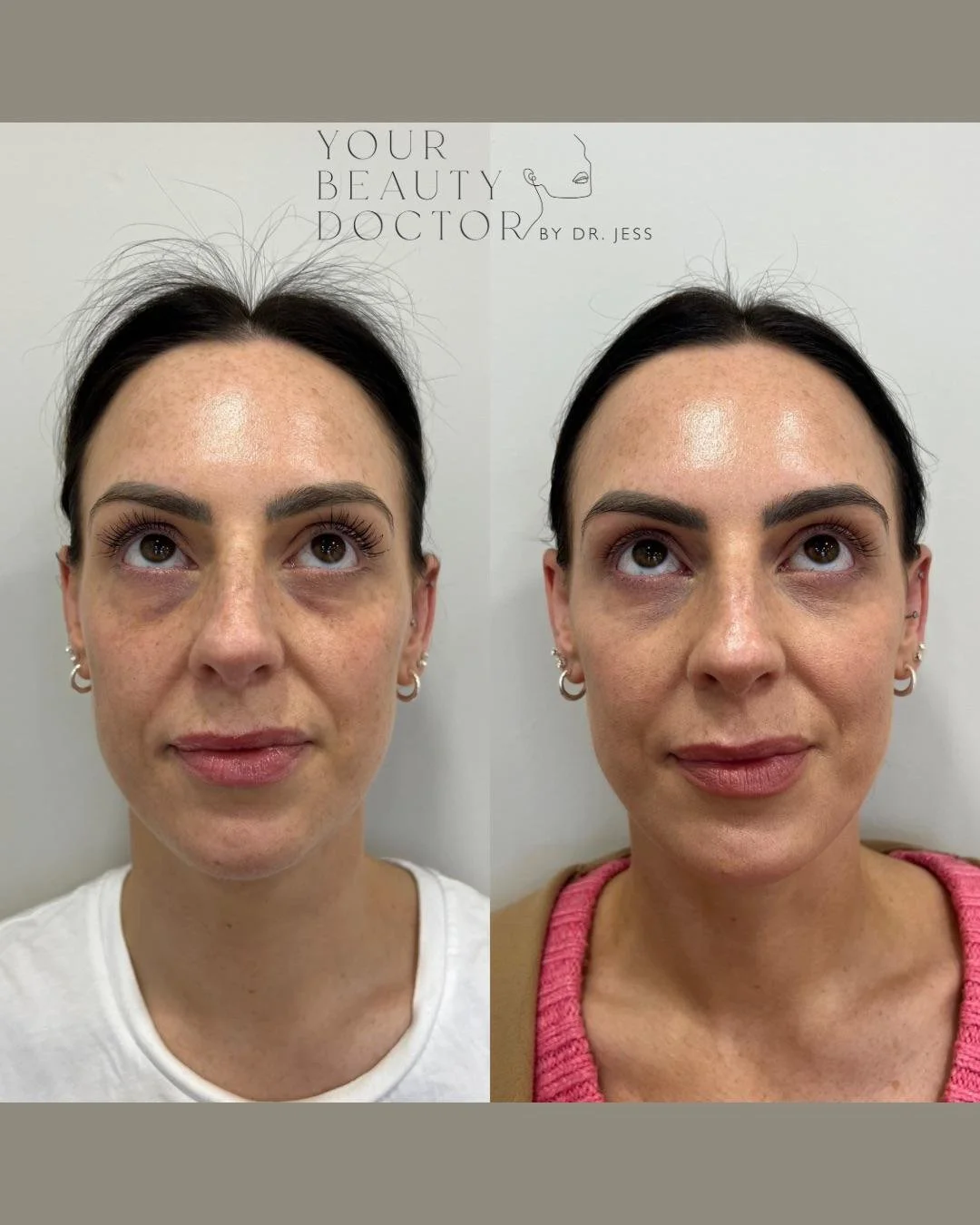 Tear Trough Fillers Nottingham