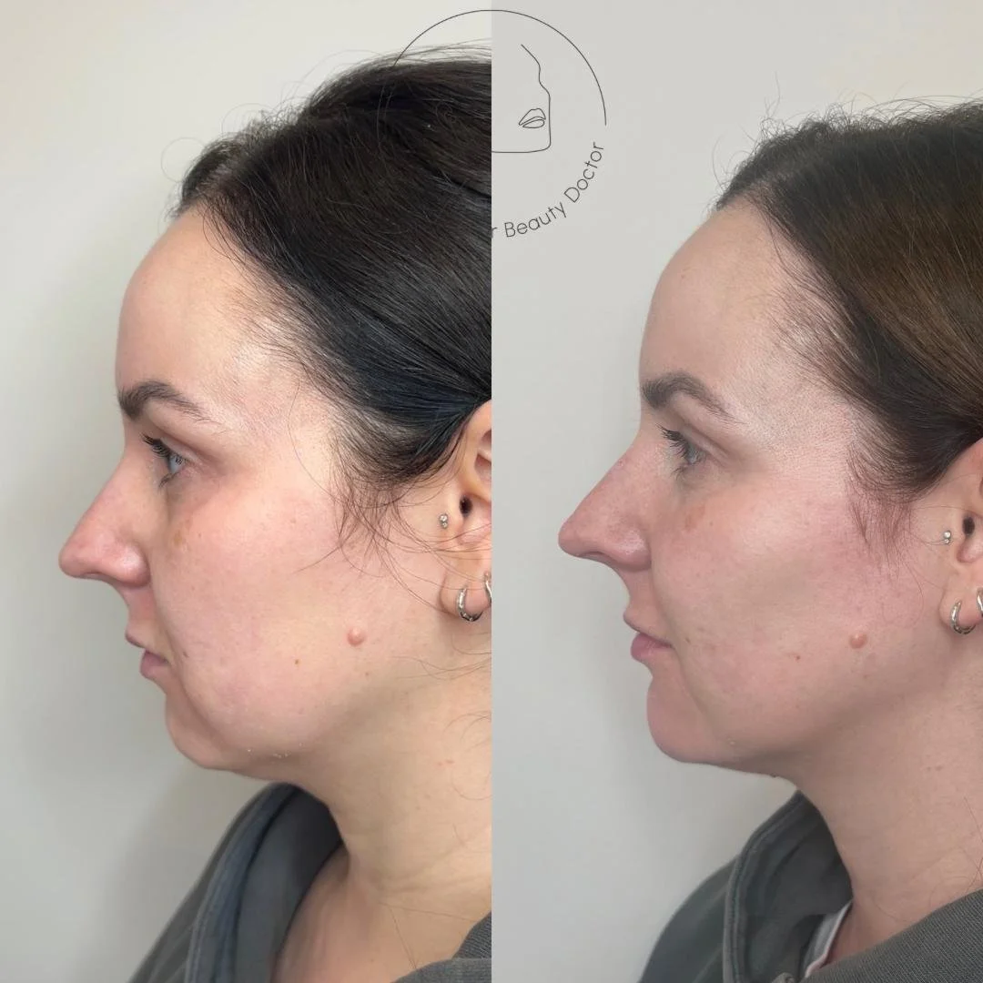 Dermal fillers rejuvenation