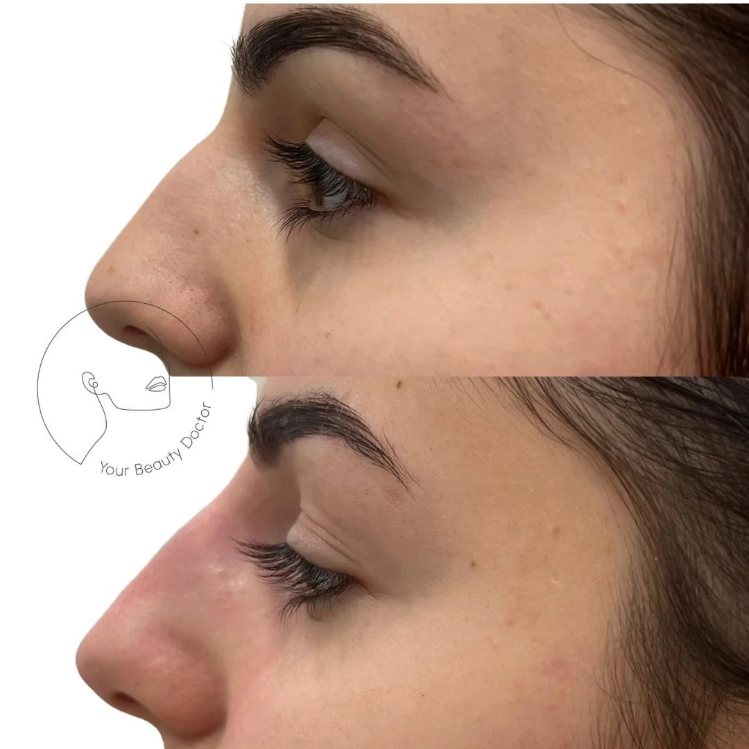Non Surgical Rhinoplasty nottingham