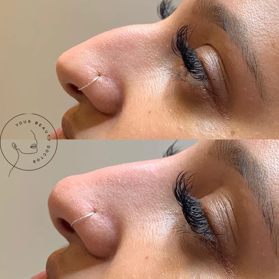 Non Surgical Rhinoplasty nottingham