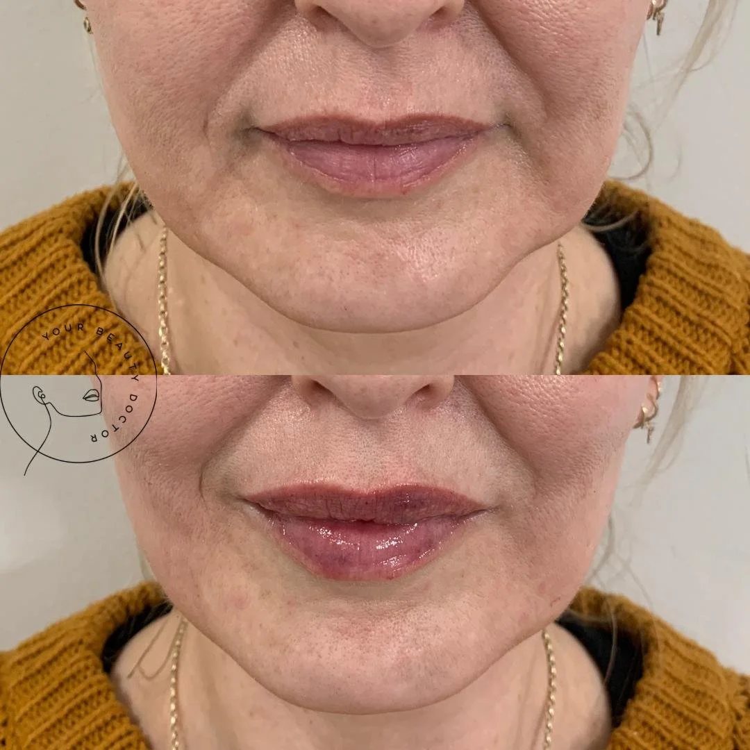 Lip filler Nottinghamshire