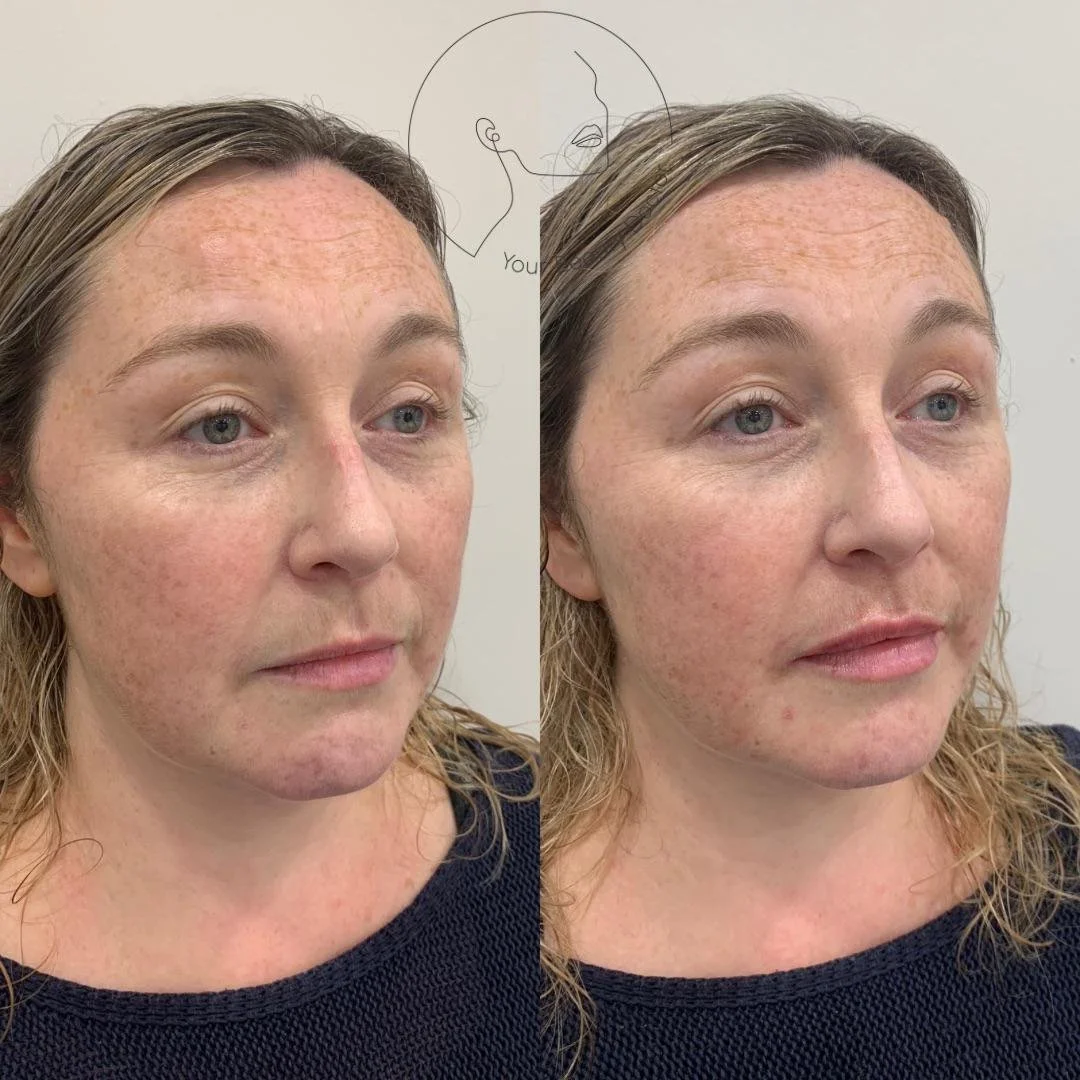 Lip filler Nottingham