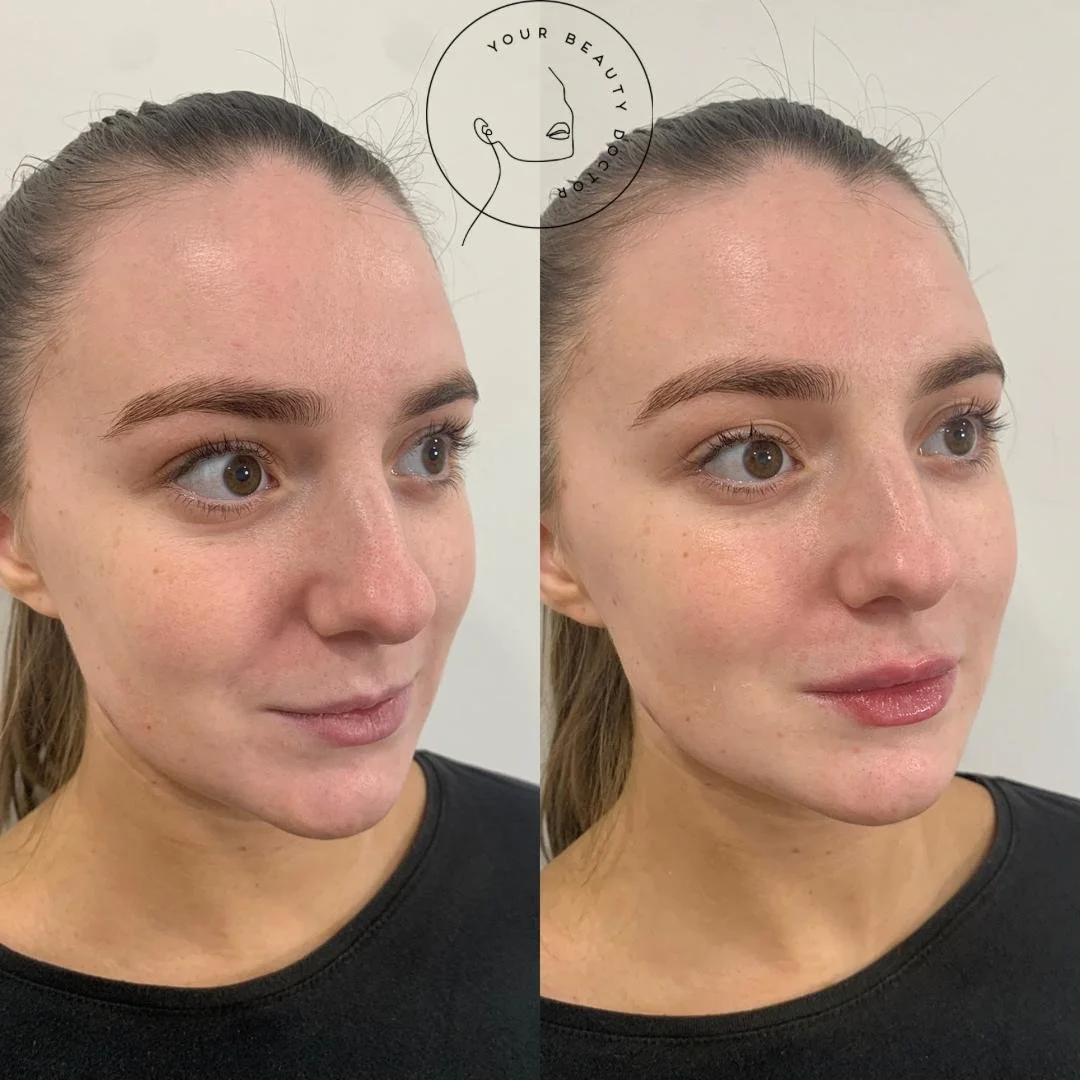 Lip filler Nottinghamshire