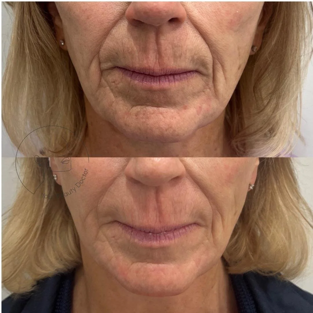 Nasolabial fold filler Nottinghamshire