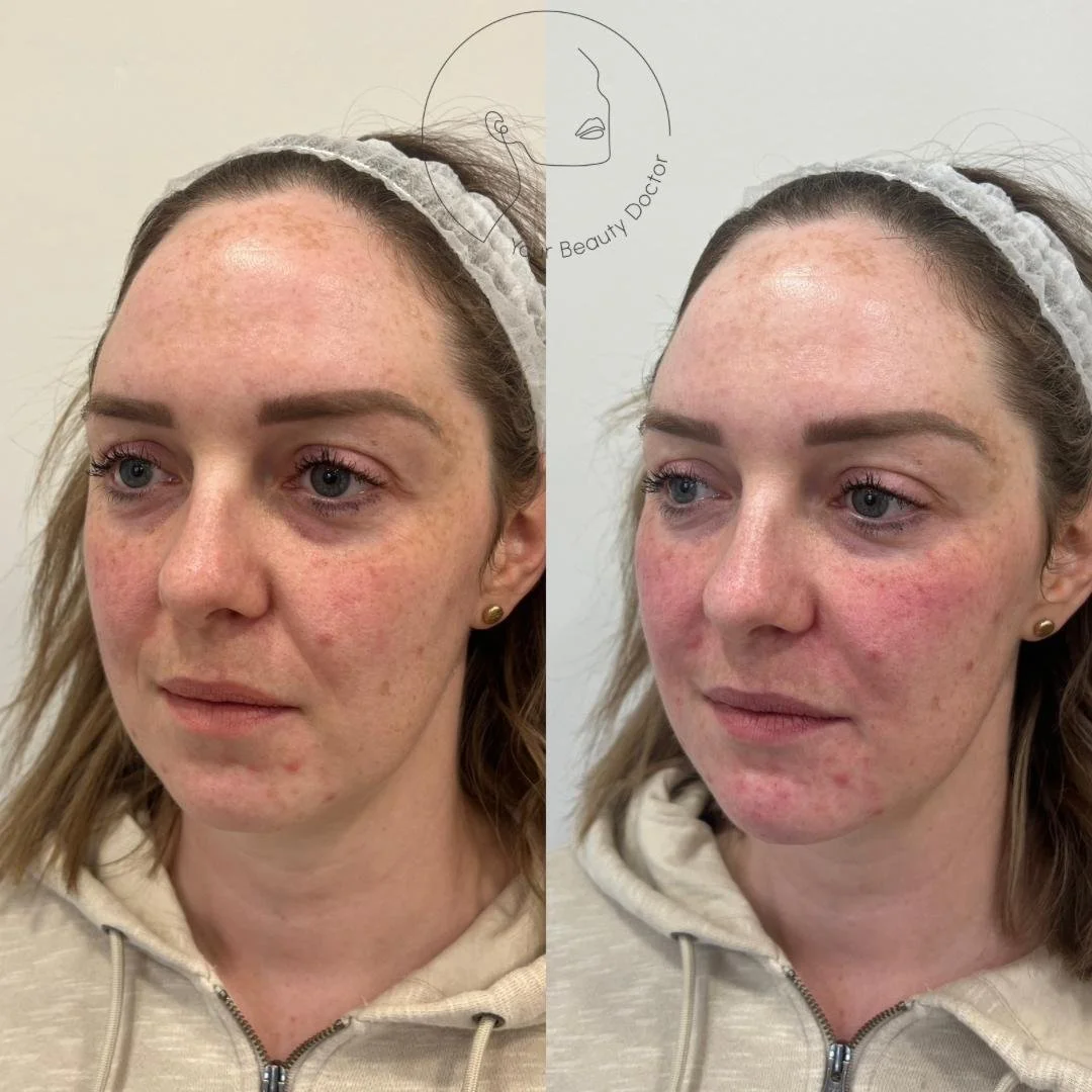Nasolabial fold filler Nottingham