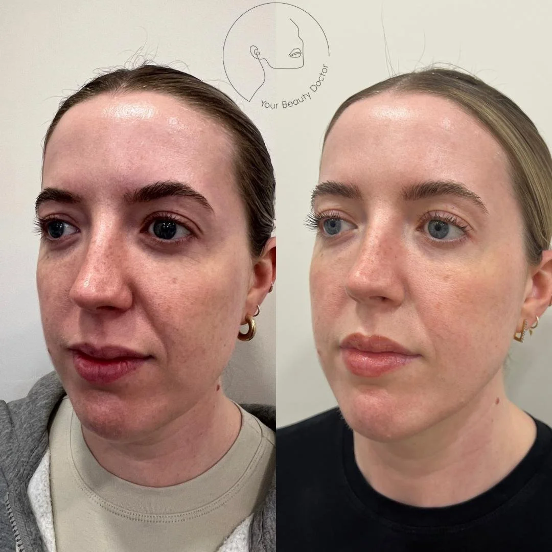 Nasolabial fold filler Nottingham