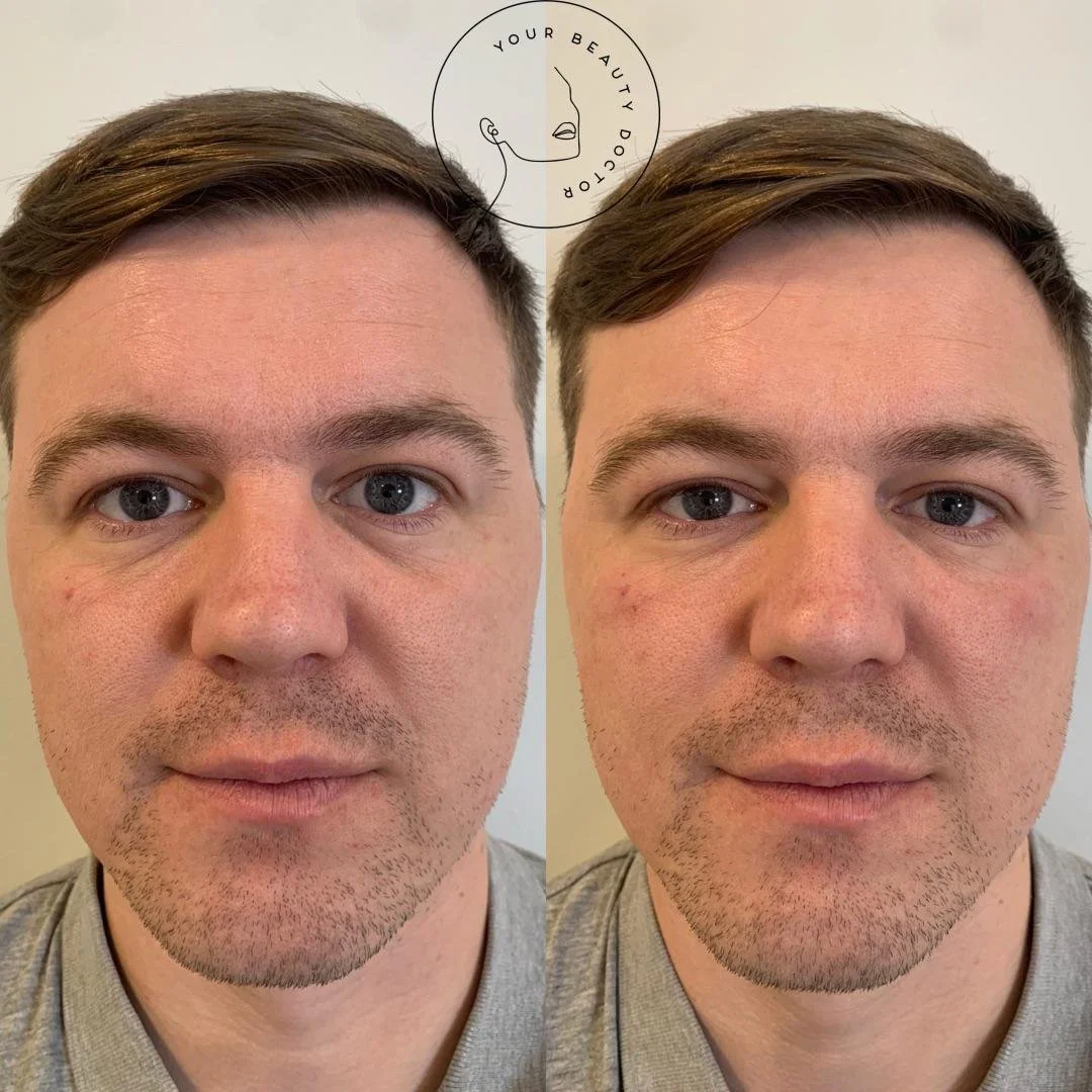 tear trough filler Nottingham