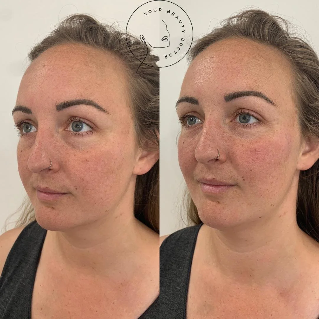 tear trough filler Nottinghamshire