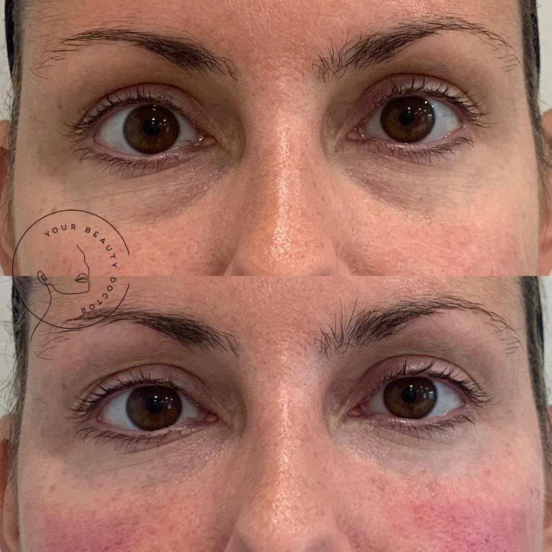 tear trough filler Nottinghamshire
