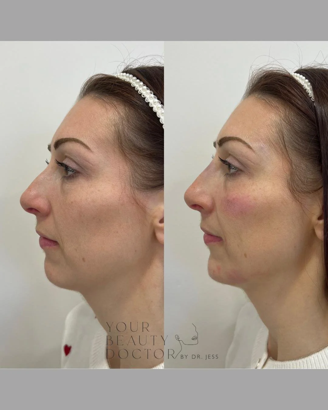 chin and jaw filler nottinghamshire