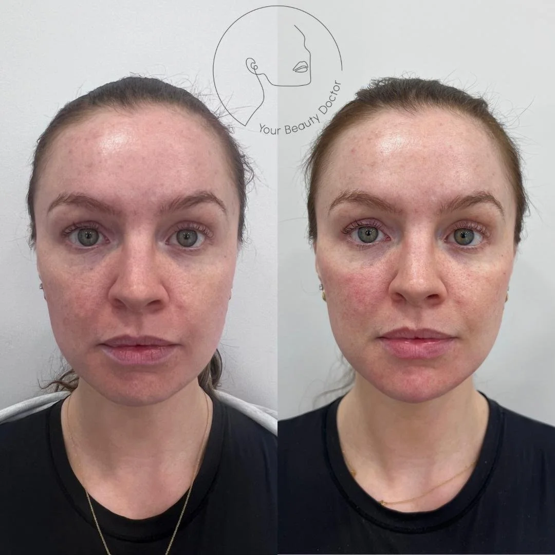 chin and jaw filler nottingham