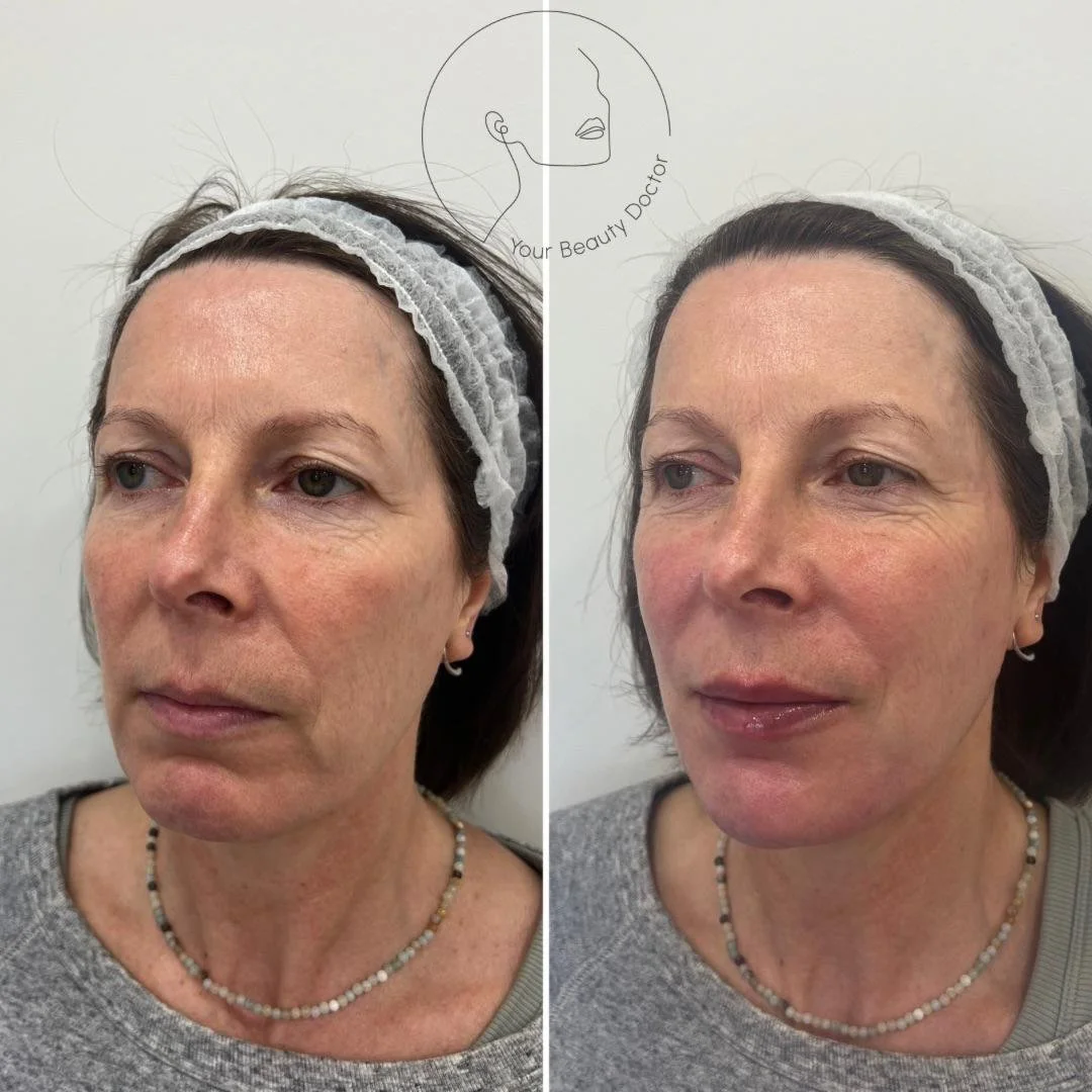 chin and jaw filler nottinghamshire