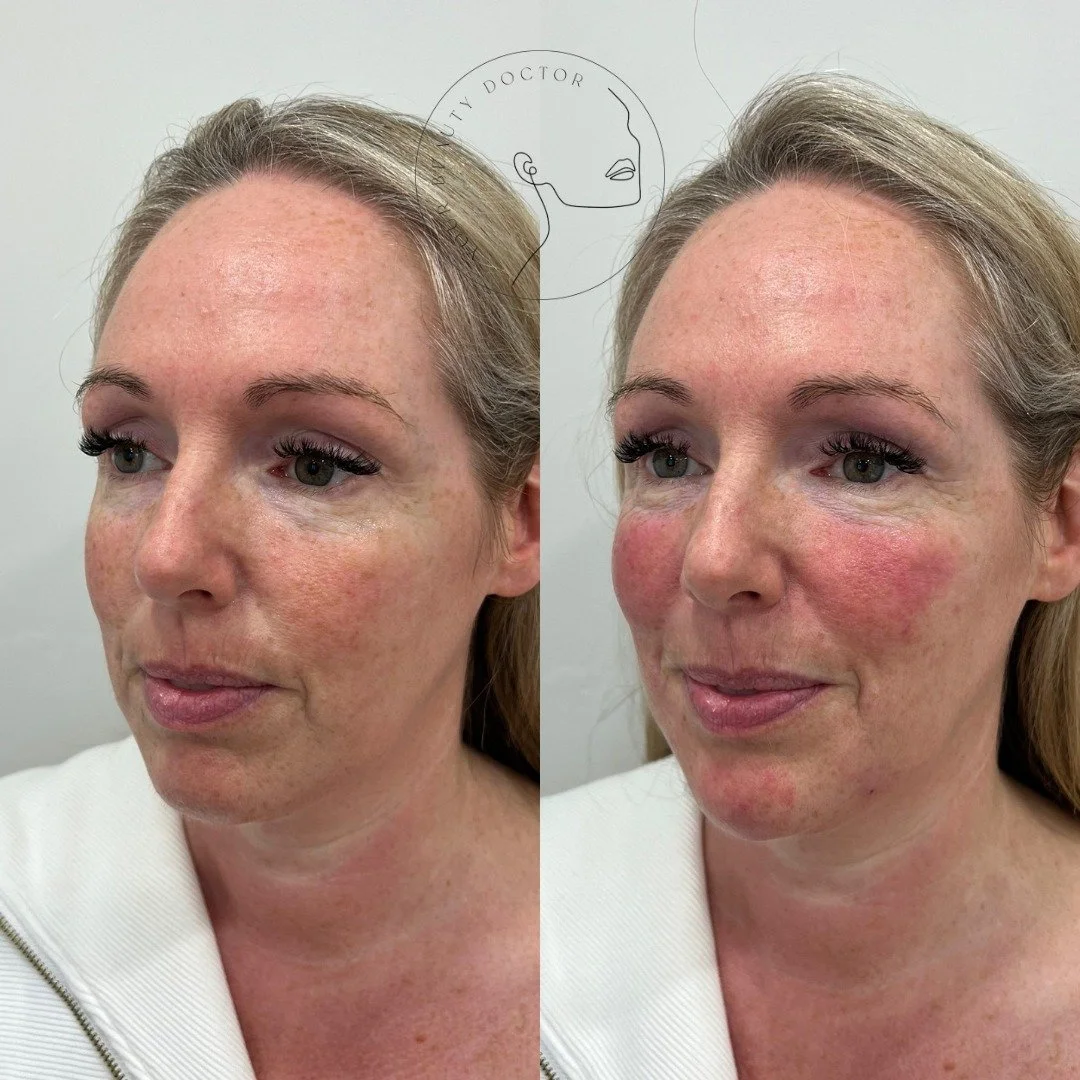 It&rsquo;s not always about looking younger.

Sometimes it&rsquo;s just about feeling more like yourself again.

This beautiful patient didn&rsquo;t want to change her face, she just wanted to soften the shadows, lift the heaviness, balance her featu