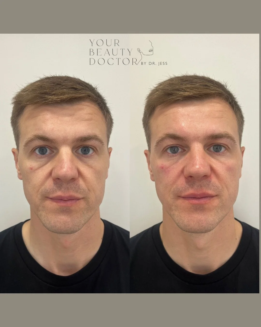 One of the most common things I hear from patients is: &quot;I always look exhausted.&quot;

And more often than not, the reason lies in the midface.

As we age, we naturally lose volume in the mid cheeks and the under-eye area drops down as a result