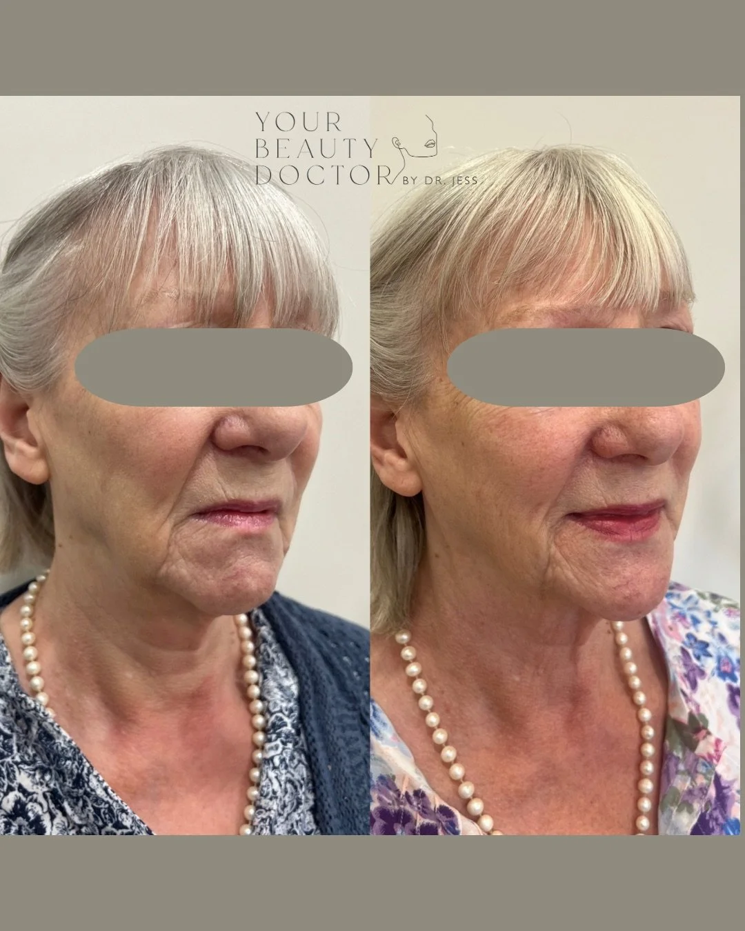 When the lower face starts to change, you really feel it.

It&rsquo;s subtle at first. A softening along the jawline. A shadow where the skin used to sit tighter. Folds that weren&rsquo;t there before, or a heaviness that seems to pull everything dow