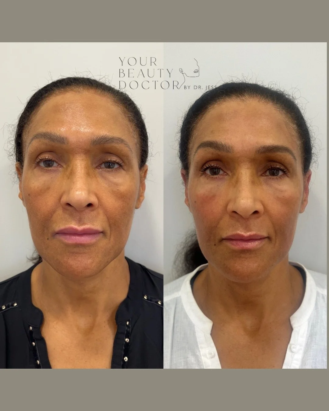 One of our favourite transformations 👆🏼

This lovely patient didn&rsquo;t want to change her face - she just wanted to bring back a bit of lift, restore her natural contour, and feel a little more like herself.

Here&rsquo;s what we did: We placed 