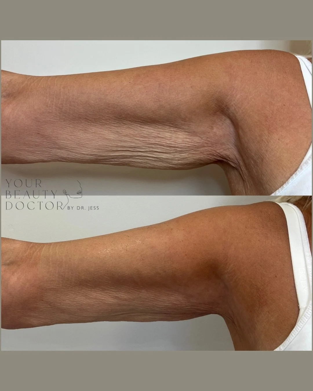 It&rsquo;s one of the most common frustrations I hear - especially from women in their 40s, 50s and beyond. You&rsquo;re doing everything right. Eating well. Staying active. Feeling stronger than ever.

But then you catch sight of your upper arms in 