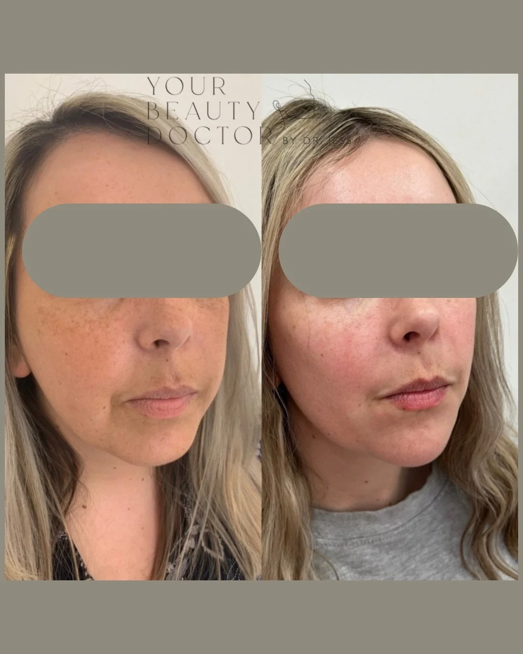 It is not always about adding more - often, it is about bringing balance back.

In the photos above, you can see the difference that thoughtful, well-placed dermal filler or the midface ans chin can make. Not to change a face, but to restore structur