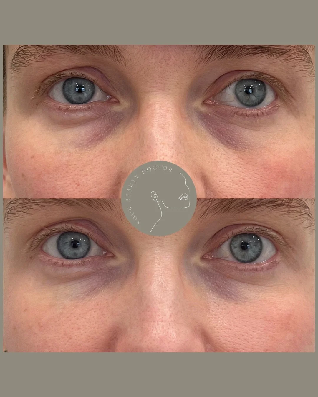 BLACK FRIDAY POLYNUCLEOTIDES OFFER NOW LIVE ON OUR BOOKING PAGE!

Brighter, fresher, more awake - after just one session ✨

This beautiful result is after a single treatment with polynucleotides under the eyes. No filler. No added volume. Just skin w