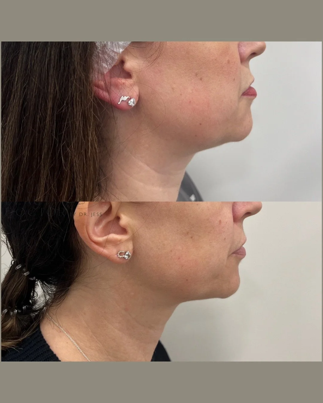 These two photos are nine months apart. What you&rsquo;re seeing is not the result of a quick fix. It&rsquo;s the subtle, cumulative effect of a regenerative approach that works with the skin to gradually restore structure and firmness.

In this case