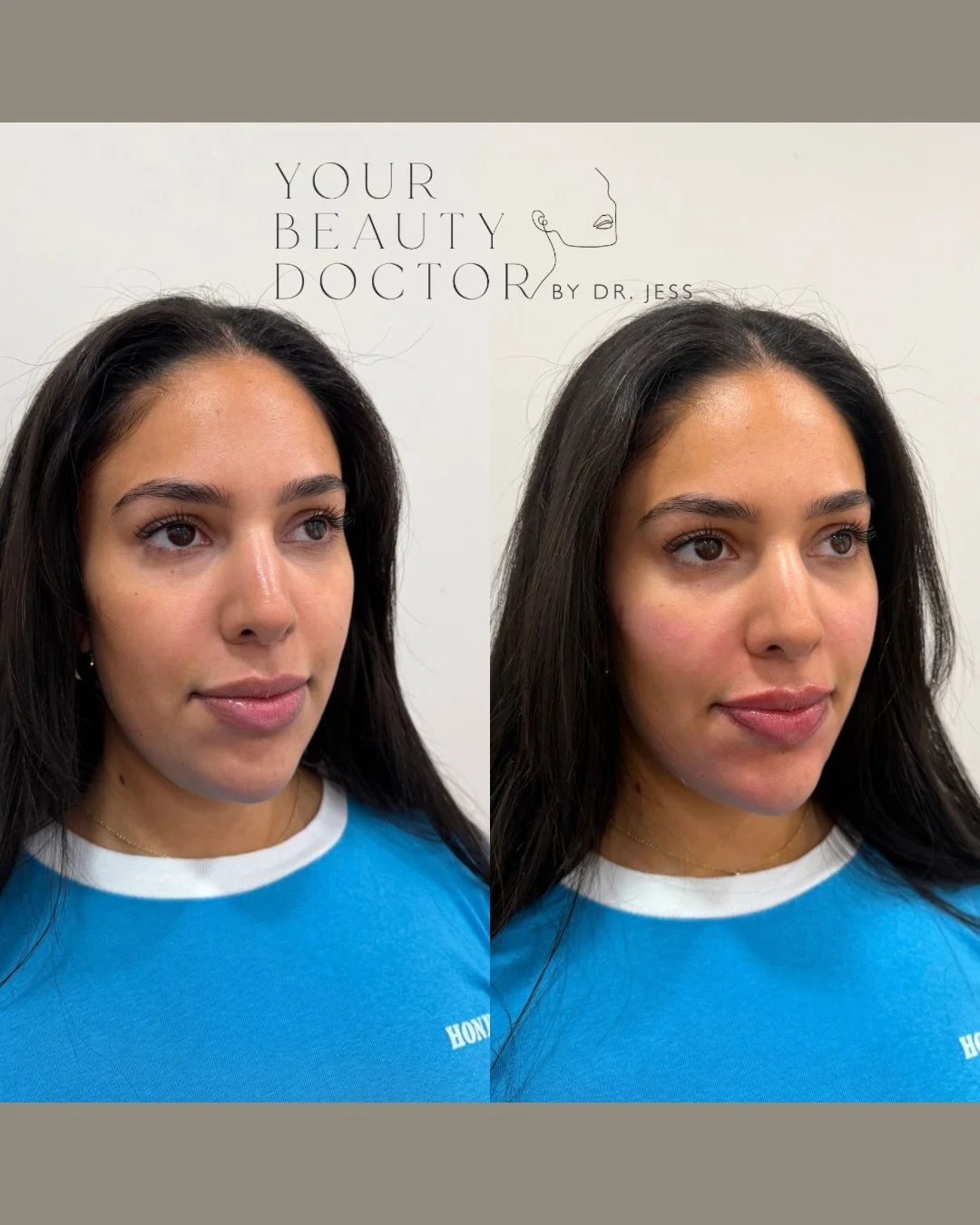 &ldquo;I don&rsquo;t want to look different. I just want to look fresher and more balanced.&rdquo;

And this is exactly what strategic, well-planned filler is meant to do.

In this case, we treated three areas that work closely together:

&bull; Chee