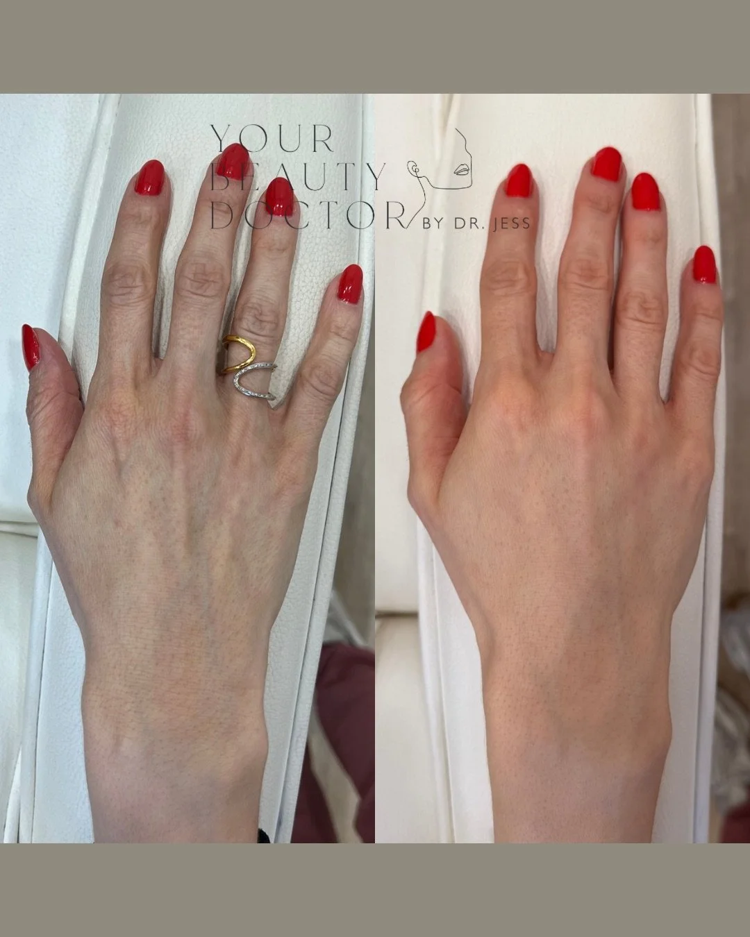 The hands are one of the most overlooked areas, yet they're often the first place where collagen loss shows. That depleted, hollow look. More visible veins and tendons. Skin that feels thinner and less supported than it used to.

Sculptra is one of t