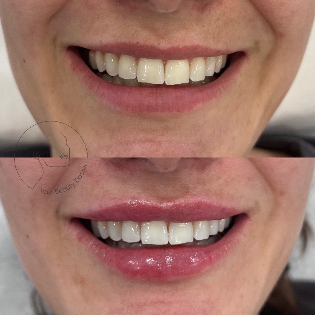 Most people who come to clinic for lip filler don&rsquo;t actually want bigger lips.

They want balance. Softness. Hydration. A shape that feels more refined but still unmistakably theirs.

That is exactly what we aimed for here.

We made small, thou