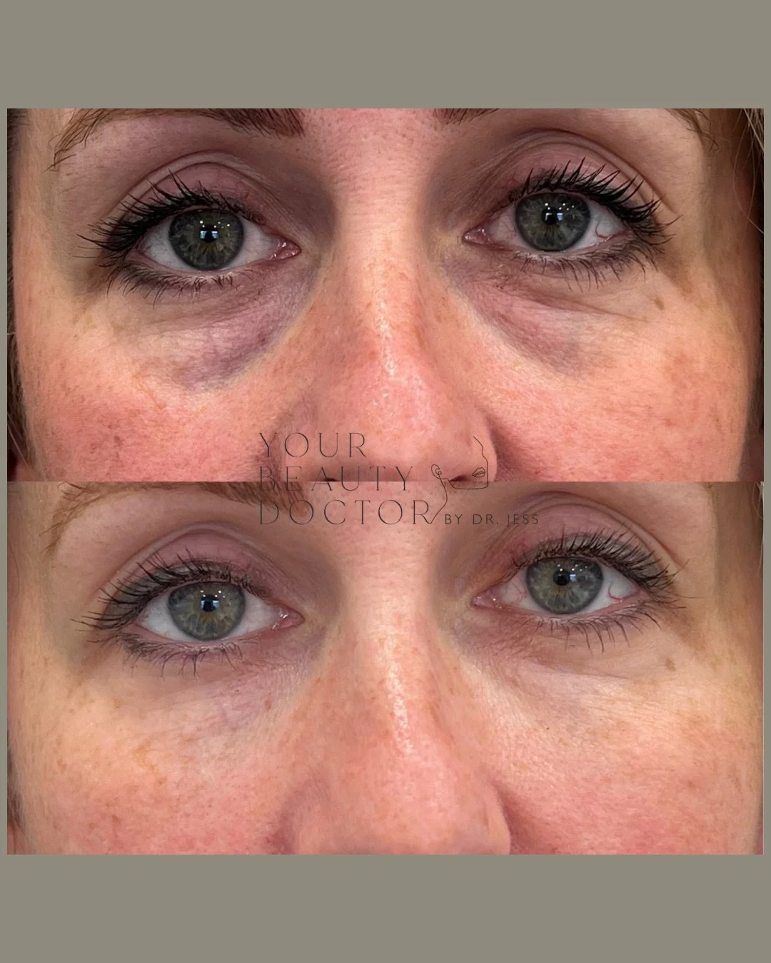 Polynucleotides + midface filler 🤝🏼 fresher, brighter under-eyes

&ldquo;I just look tired all the time, even when I&rsquo;m not,&rdquo; is the sentence we hear most when someone comes in worried about their under-eyes. This transformation is a rea