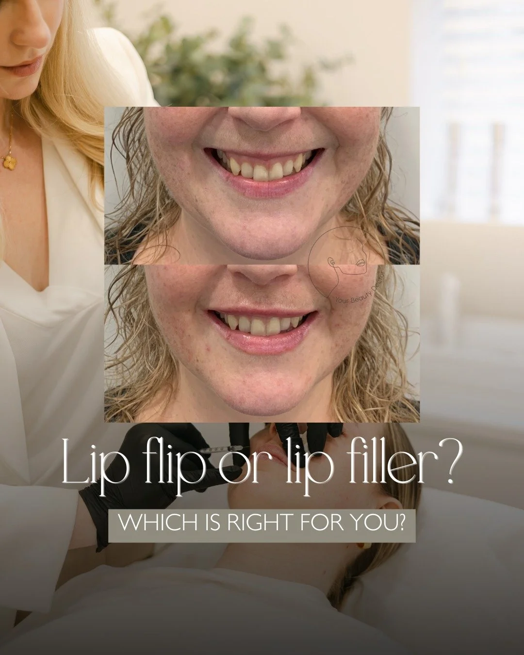 Lips are one of the most common areas people feel unsure about 👄

You want a little more shape or definition, but you don't want to look overdone. You want to feel confident, not self-conscious. And you want results that enhance your face rather tha