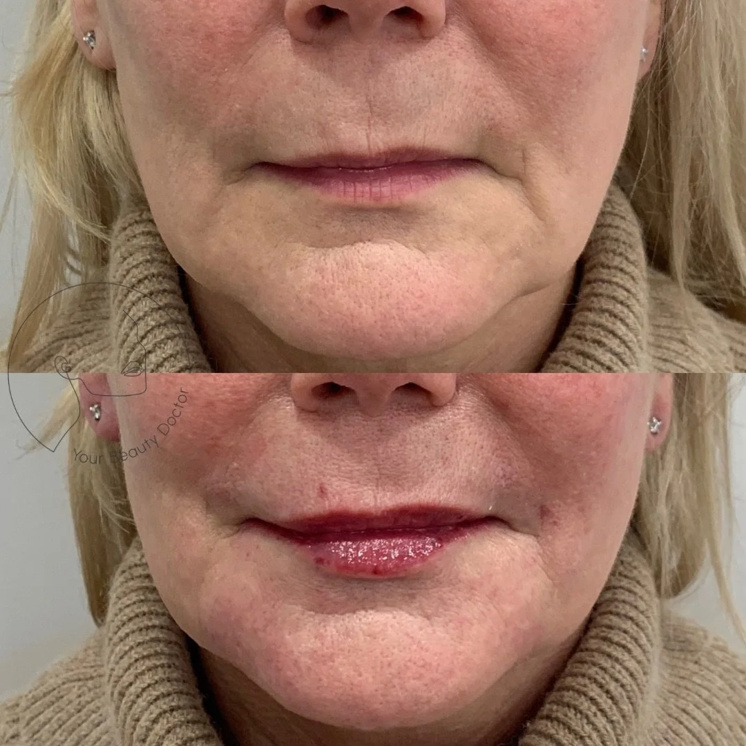 This is what natural lip filler looks like when the goal isn&rsquo;t volume, but restoration 👆🏼

With time, lips don&rsquo;t just lose fullness. They lose hydration, definition and support, which can make the mouth look tighter, flatter and a littl