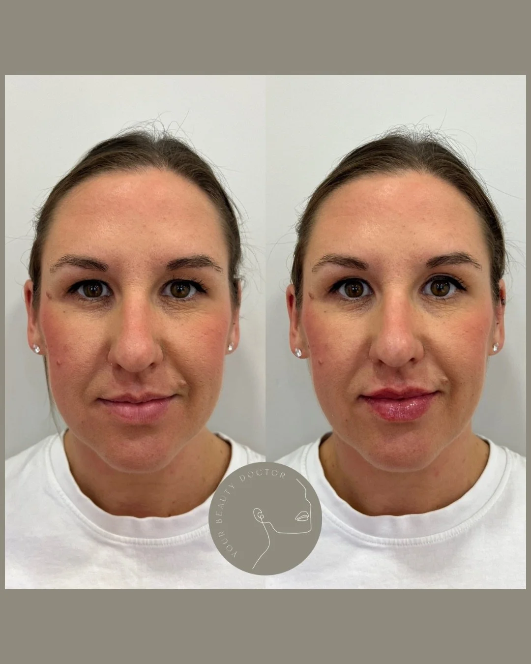 Lips are never just about lips. When they are treated well, they bring balance to the entire face.

A small, thoughtful amount of filler can soften proportions, refine the profile and create a sense of harmony that looks effortless and completely nat