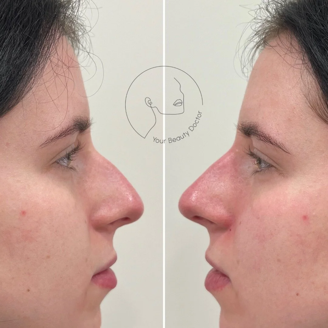 Non-surgical rhinoplasty is one of the most rewarding and powerful treatments to perform because it can change the entire balance of the face with minimal downtime 👃🏽

This patient was conscious of her side profile, and felt it didn&rsquo;t quite f
