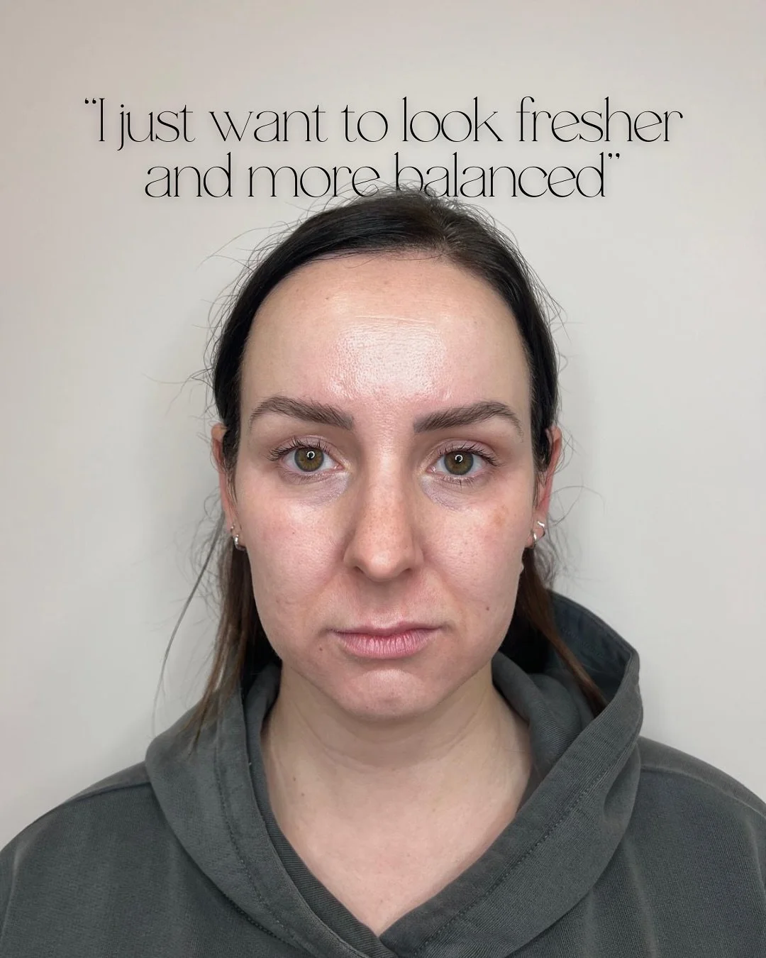 &ldquo;I just want to look fresher and more balanced&rdquo; is one of the most common things I hear in clinic, and it&rsquo;s exactly what strategically-placed filler is designed to do 💉

It&rsquo;s about small shifts that make everything sit better