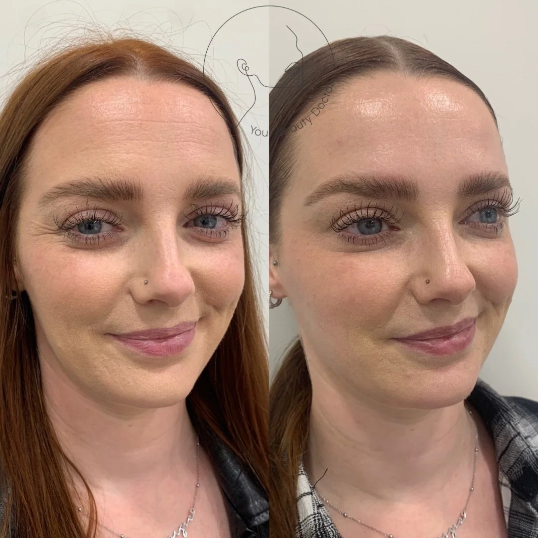A lot of people worry that anti-wrinkle treatment means looking frozen or like they&rsquo;ve &ldquo;had something done&rdquo;.

In the right hands, that's never the case.

Here, we treated the upper face early and conservatively. The intention wasn&r