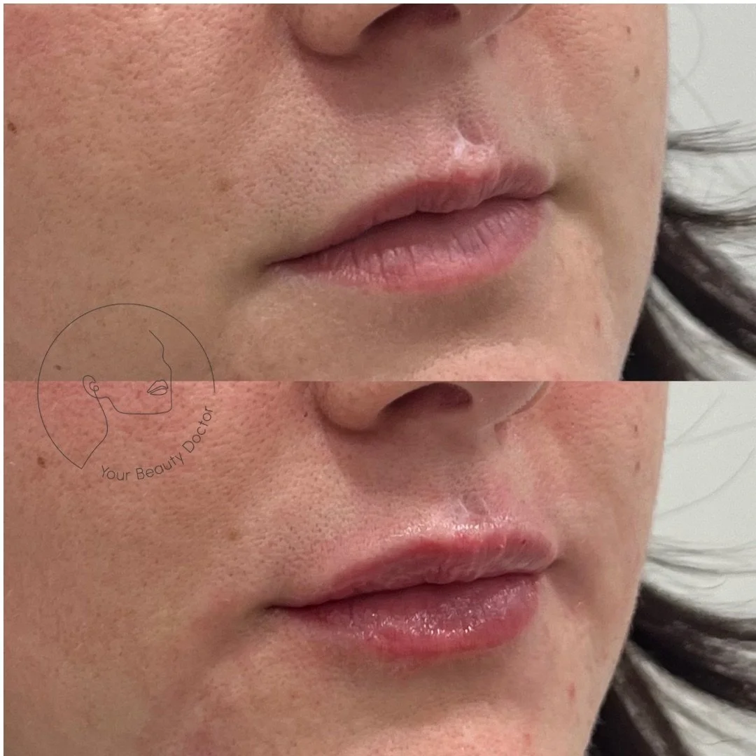 This is what lip filler looks like when it&rsquo;s done with balance in mind. Our lovely patient had experienced trauma to her upper lip, and we were able to minimise the appearance of the resulting scarring and asymmetry, and balance the overall pro