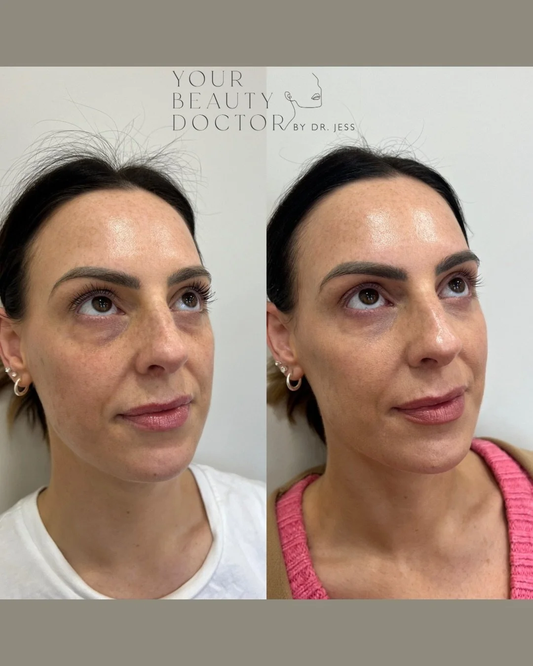 Tear trough filler is one of the most misunderstood treatments, and it can rarely be performed in isolation: usually the midface will need some filler support too.

It&rsquo;s also not going to answer all of your under-eye concerns e.g crepiness or p