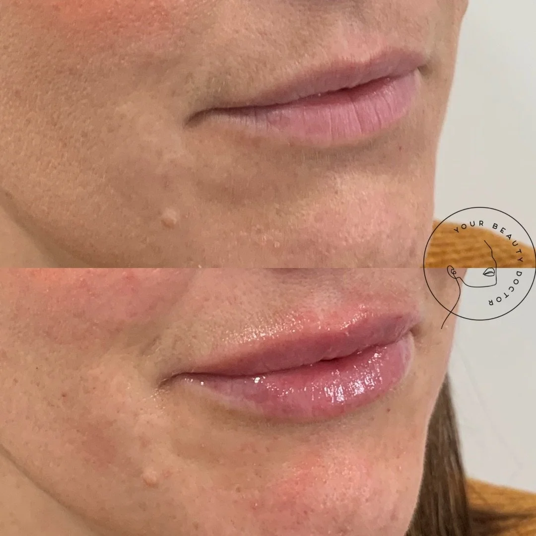 This is the kind of lip filler most people say they want, even if they don&rsquo;t realise it yet 👄

A lot of patients come in saying they&rsquo;re scared of lip filler because they don&rsquo;t want to look &ldquo;done&rdquo;. What they&rsquo;re rea