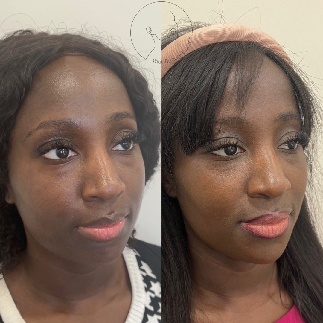 The power of the chin ✨This is one of those treatments that's just a small tweak, but makes a huge difference to the balance of the whole face.

When the chin sits a little short or lacks projection, the lower face can look heavier, softer, and less 