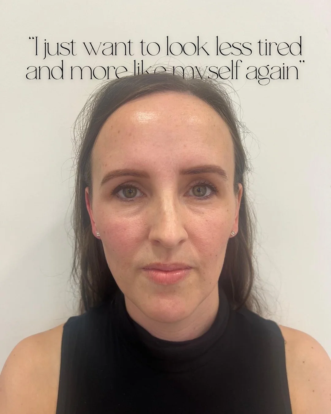 &ldquo;I just want to look less tired.&rdquo; We hear this a lot in clinic.

Usually, it&rsquo;s not down to just one obvious thing. It&rsquo;s a combination of small changes that happen gradually. A bit of volume loss through the cheeks, a little le