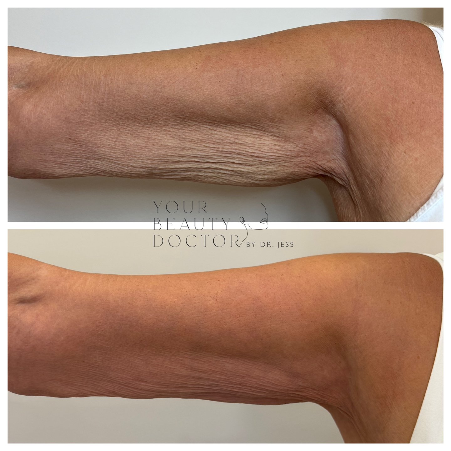 As we get older, the skin on the upper arms often becomes crepey and we can start to get self conscious, This can often happen with weight loss in younger patients too.

It&rsquo;s not just how it looks, it&rsquo;s how it feels. A bit thinner, a bit 