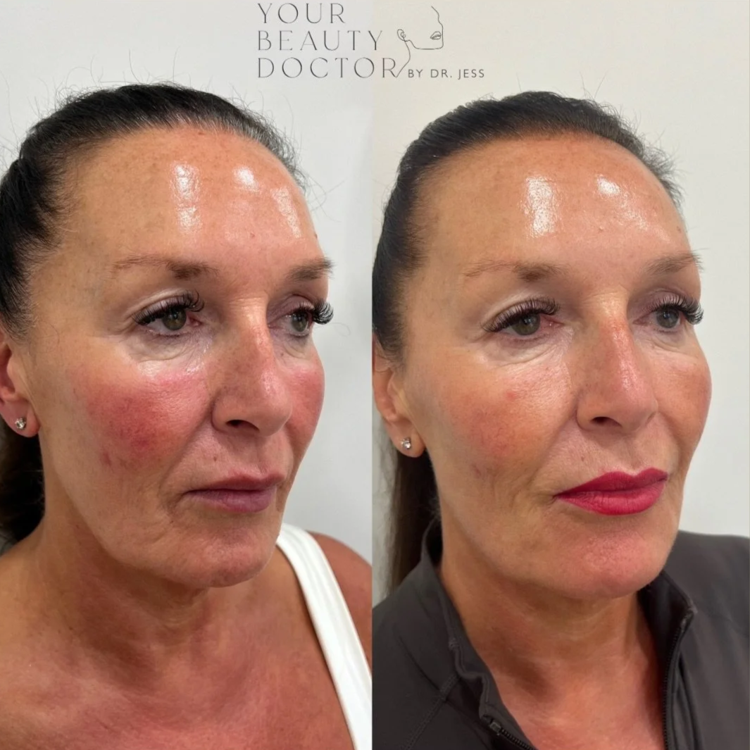 Sofwave non surgical facelift Nottingham