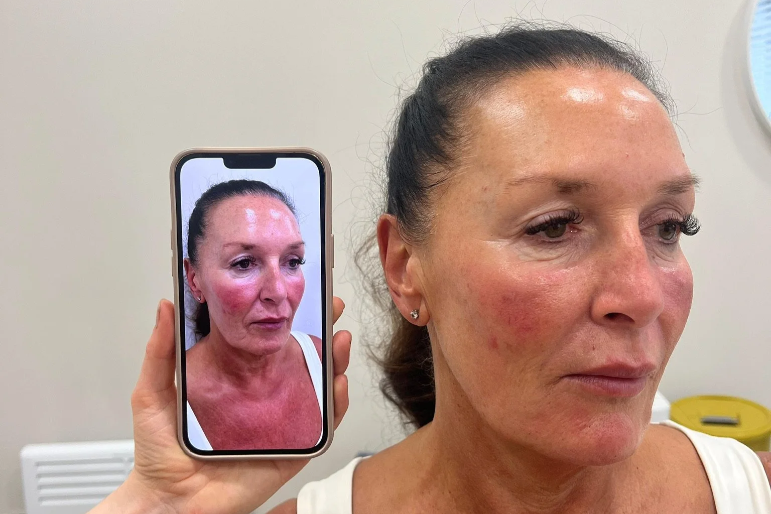 Skinpen Micro needling