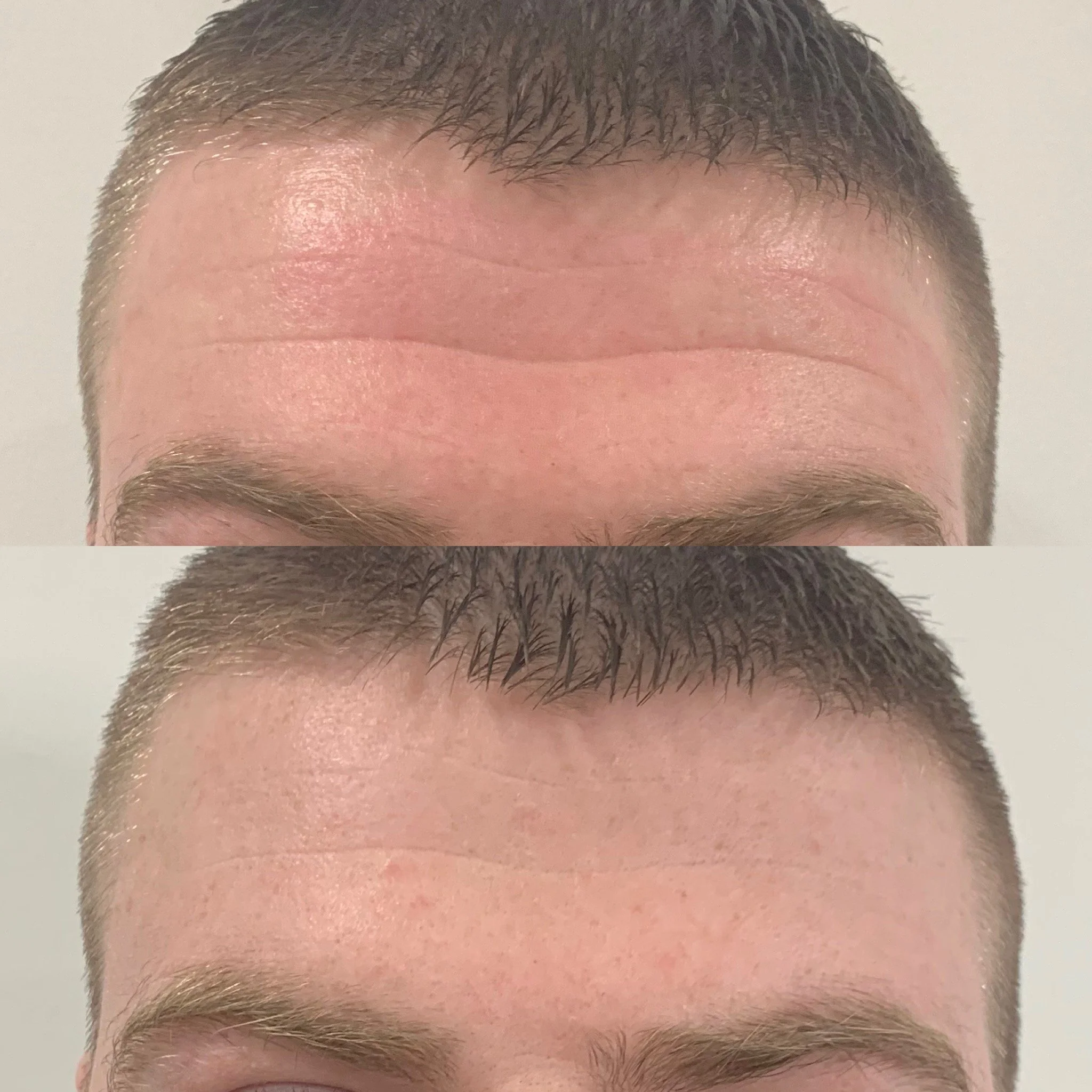 anti wrinkle treatment nottingham